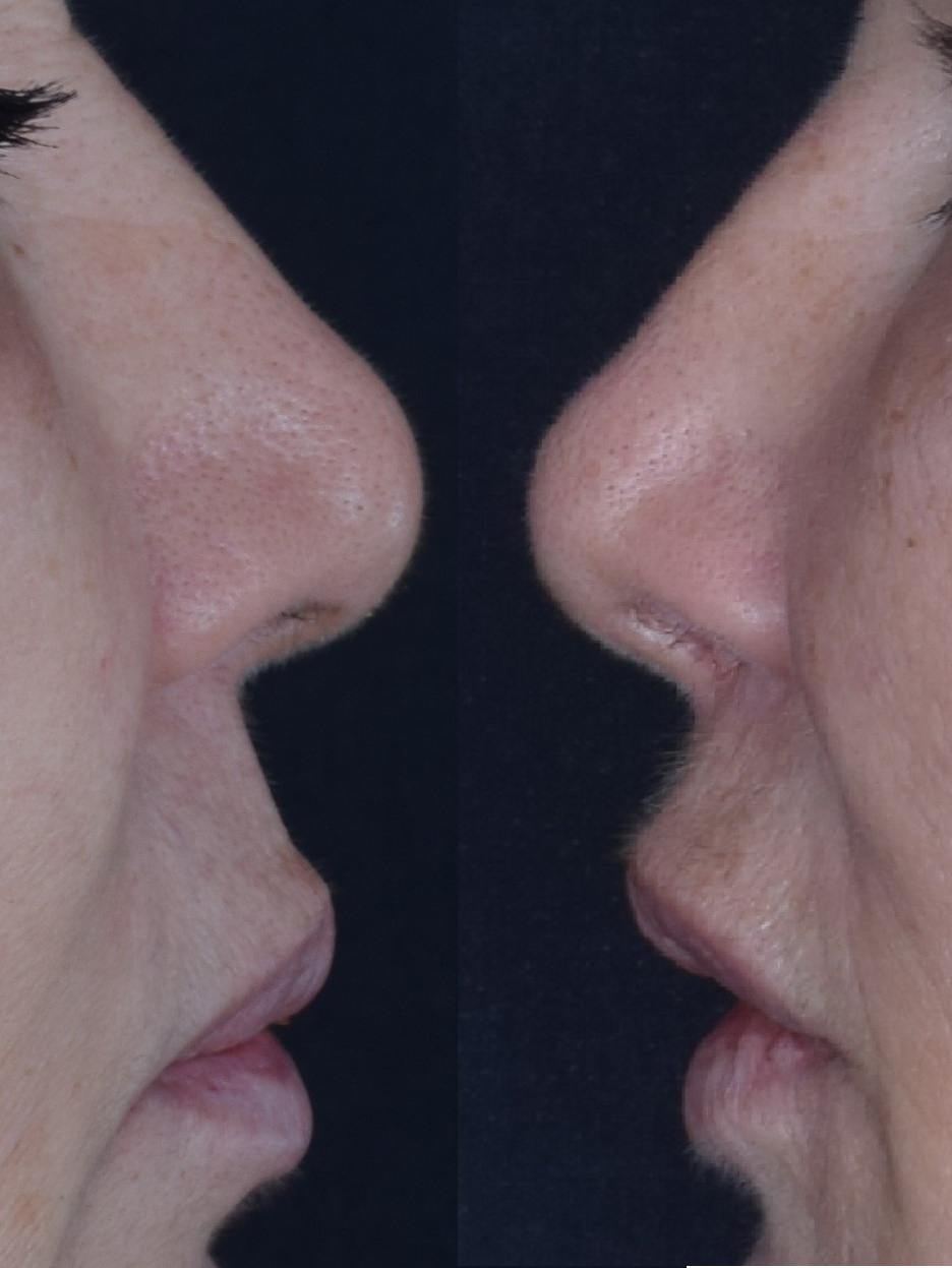 Figure 3 : Before and 6 months after photos demonstrates providing volume on the nasal spine and under the base of the nose, which can improve the upper lip convexity that causes causes an aged, simian appearance, and increase the nasolabial angle as well as shortens the lip.